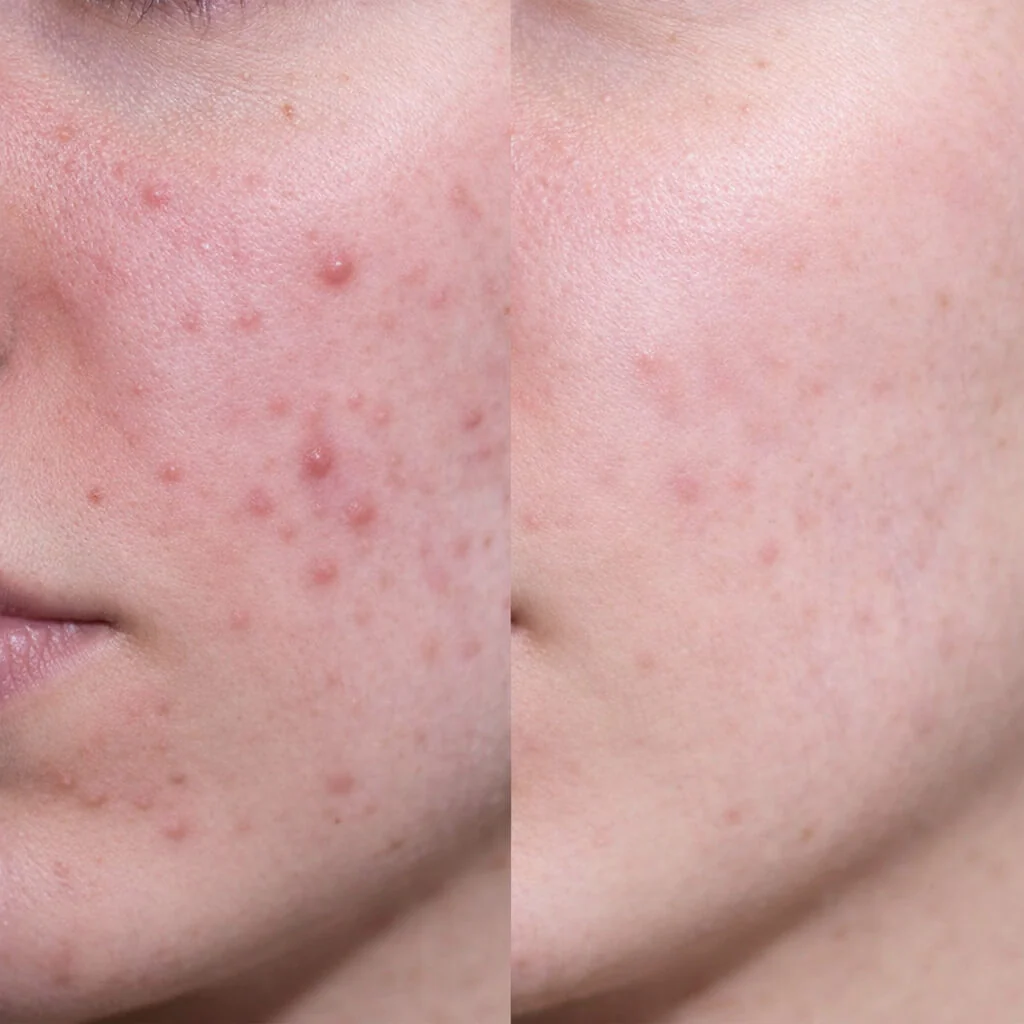 Crème Hydratante Visage à l’Acide Salicylique pour boutons et points noirs — Crème Visage légère et non grasse à l’acide salicylique peau grasse et impure – nettoie les pores et purifie la peau. - Image 6