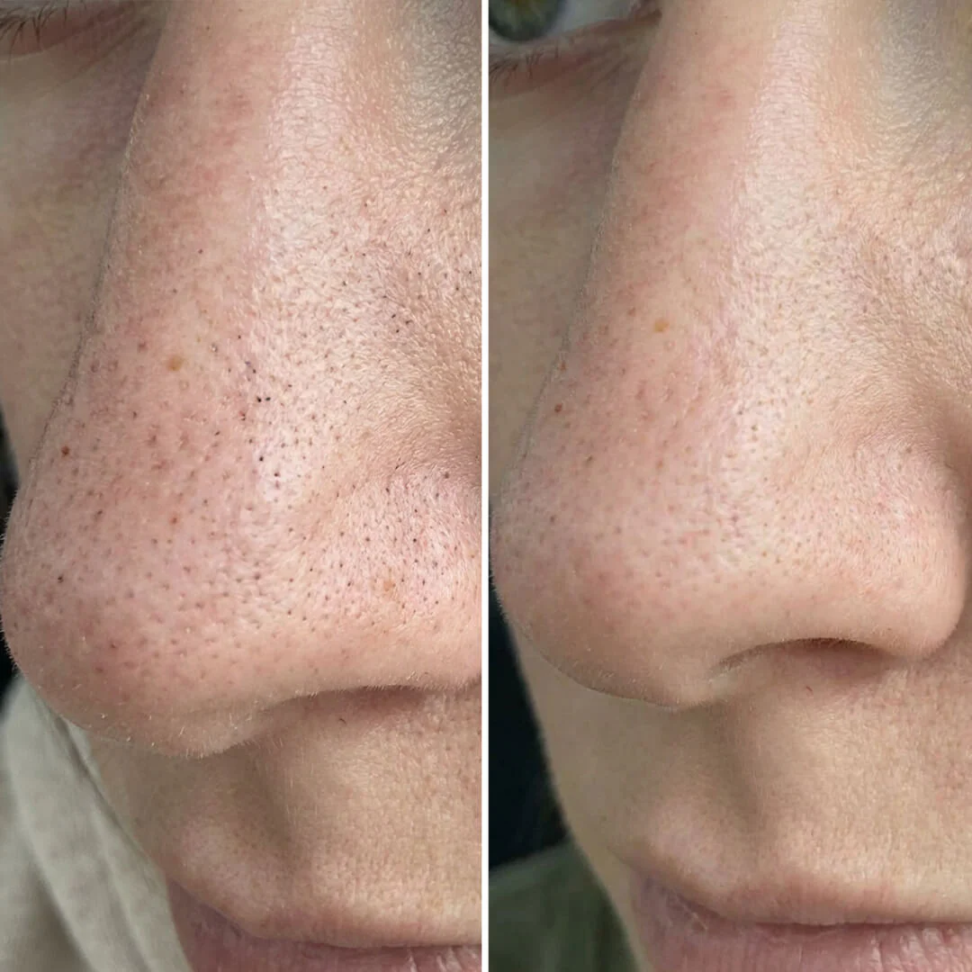 Kit Points Noirs & Pores – Nettoyage à l’Acide Salicylique — Kit pores obstrués et imperfections. Nettoyez et hydratez pour un résultat net. Contient de l'acide salicylique pour une action profonde. - Image 6