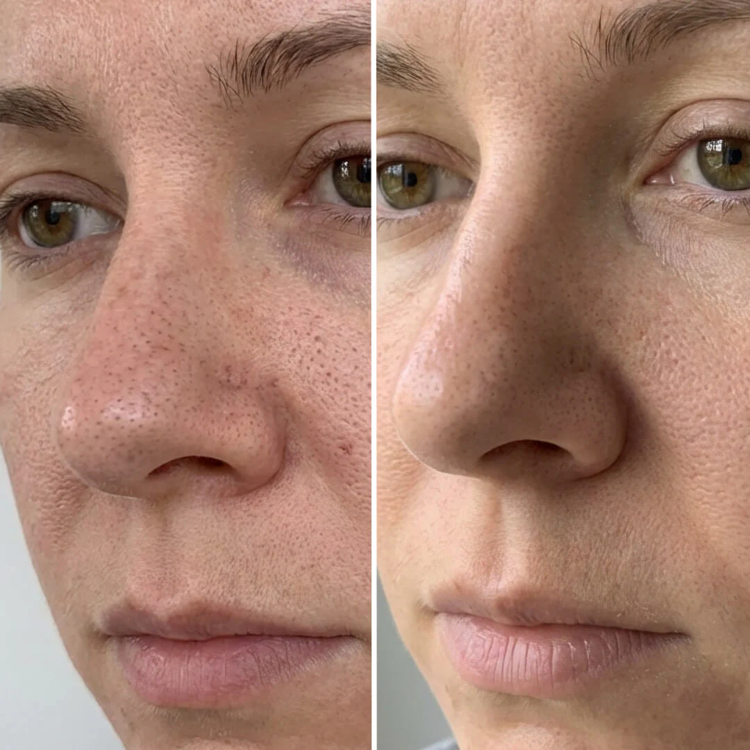 Kit Points Noirs & Pores – Nettoyage à l’Acide Salicylique — Kit pores obstrués et imperfections. Nettoyez et hydratez pour un résultat net. Contient de l'acide salicylique pour une action profonde. - Image 7