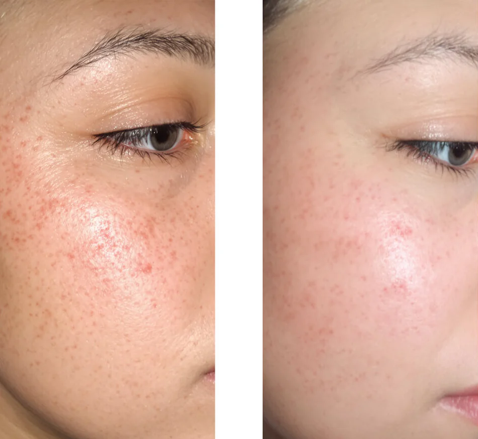 Sérum acide salicylique pour points noirs et peau grasse — Sérum à l’acide salicylique pour peau grasse, pores et points noirs. Contient Zinc PCA, thé vert, acide hyaluronique et glycérine. - Image 6