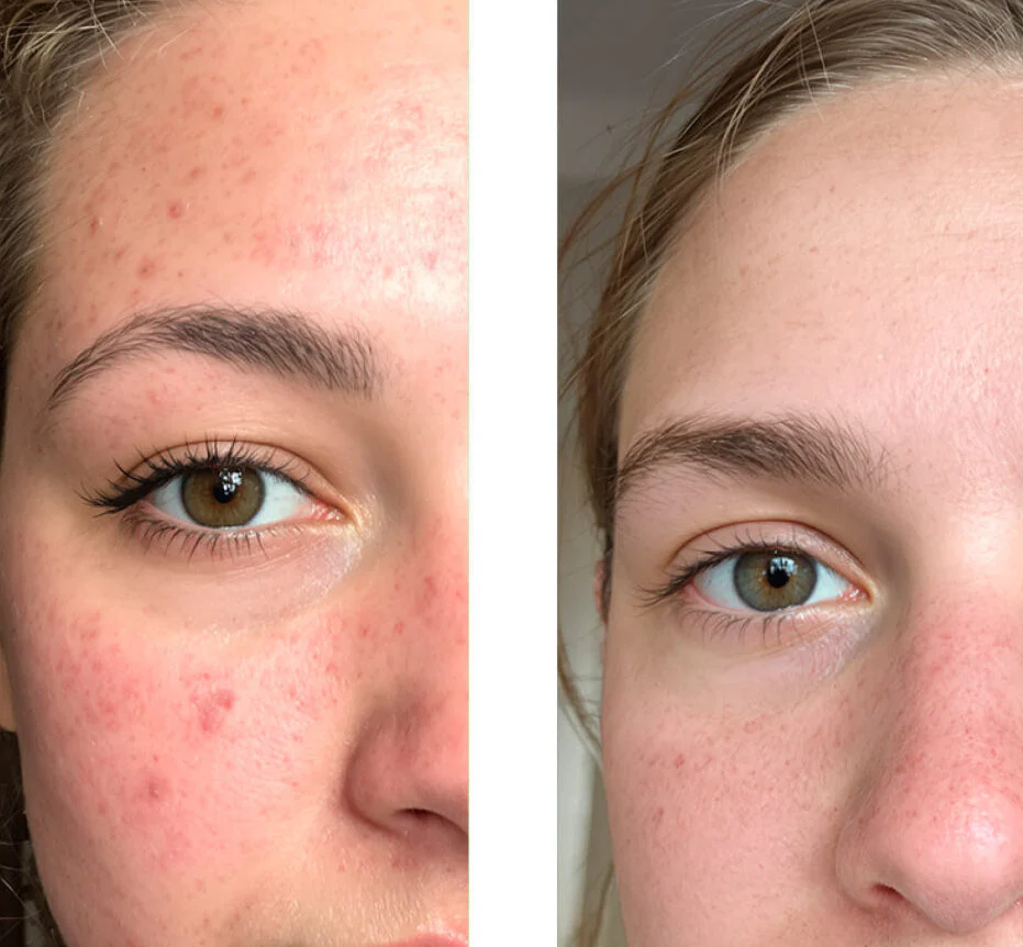 Tonique à l'acide salicylique pour pores et boutons — Ce peeling/exfoliant à l'acide salicylique réduit les pores, les boutons et l'excès de sébum. Parfait pour purifier la peau au quotidien. - Image 6