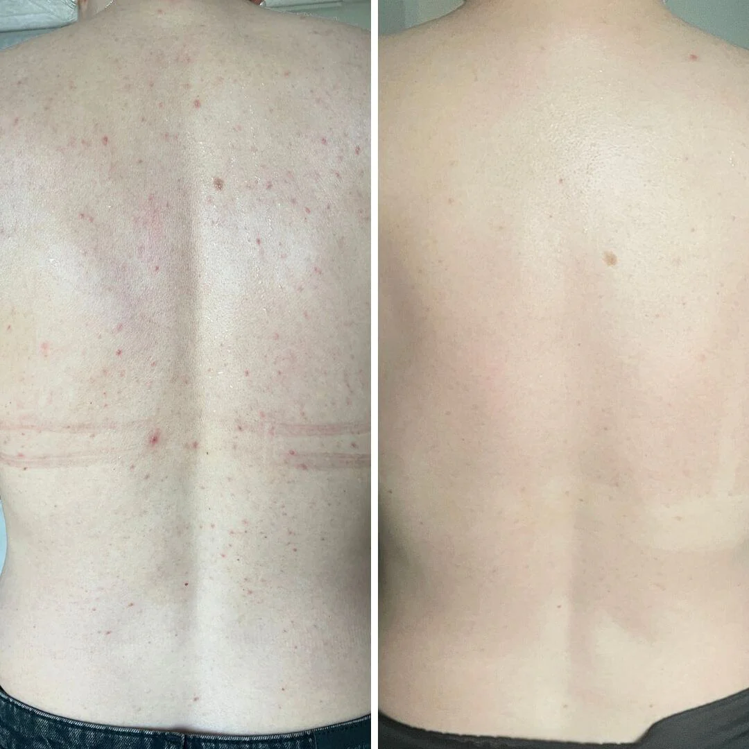 Spray à l’acide salicylique pour boutons et pores obstrués — Spray contre boutons et pores bouchés. Contient 2 % d’acide salicylique et acide glycolique pour purifier et lisser la peau. - Image 6